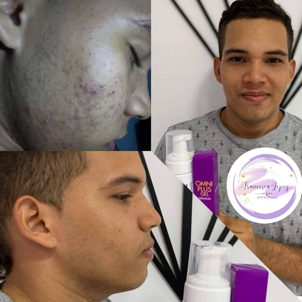 kit acne